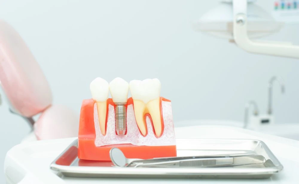 Sakarya'da İmplant Tedavisi: Fiyatları, Süreci ve Bilmeniz Gereken Her Şey